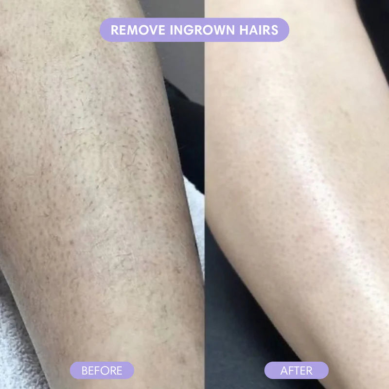INGROWN HAIR